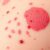 Wyprysk alergiczny: objawy, diagnostyka i metody leczenia