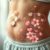 Endometrioza: Objawy, leczenie i wpływ na płodność kobiet